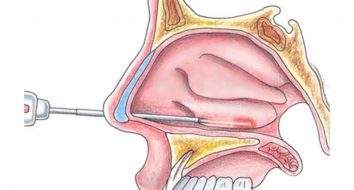Что такое вазотомия носовых раковин и в каких случаях она нужна